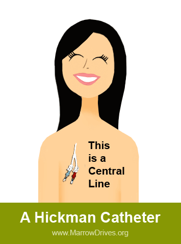 Hickman Catheter
